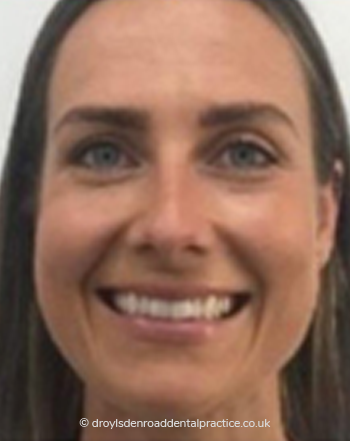 Invisalign Transformations