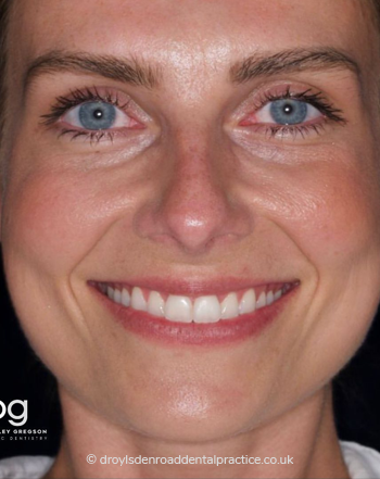 Invisalign Transformations